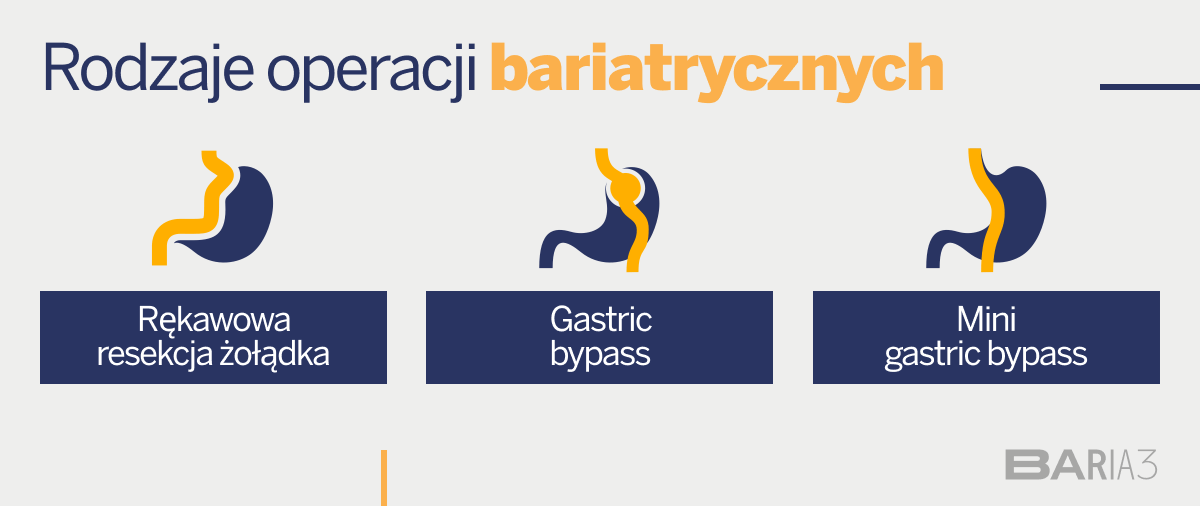 Rodzaje operacji bariatrycznych - Baria3