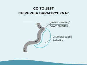 Czy operacja bariatryczna powinna być pierwszym krokiem w leczeniu otyłości?