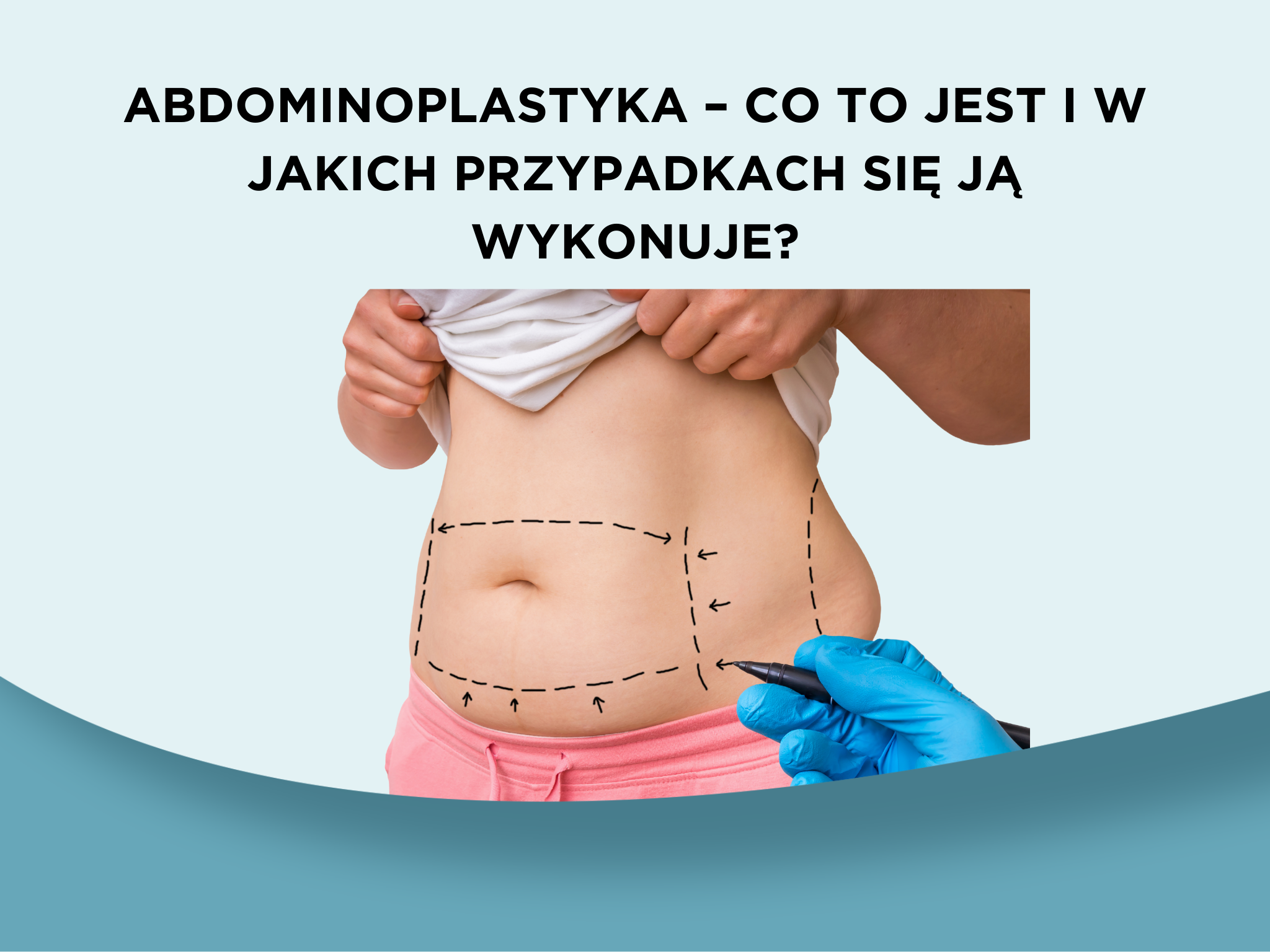 Abdominoplastyka – co to jest i w jakich przypadkach się ją wykonuje?