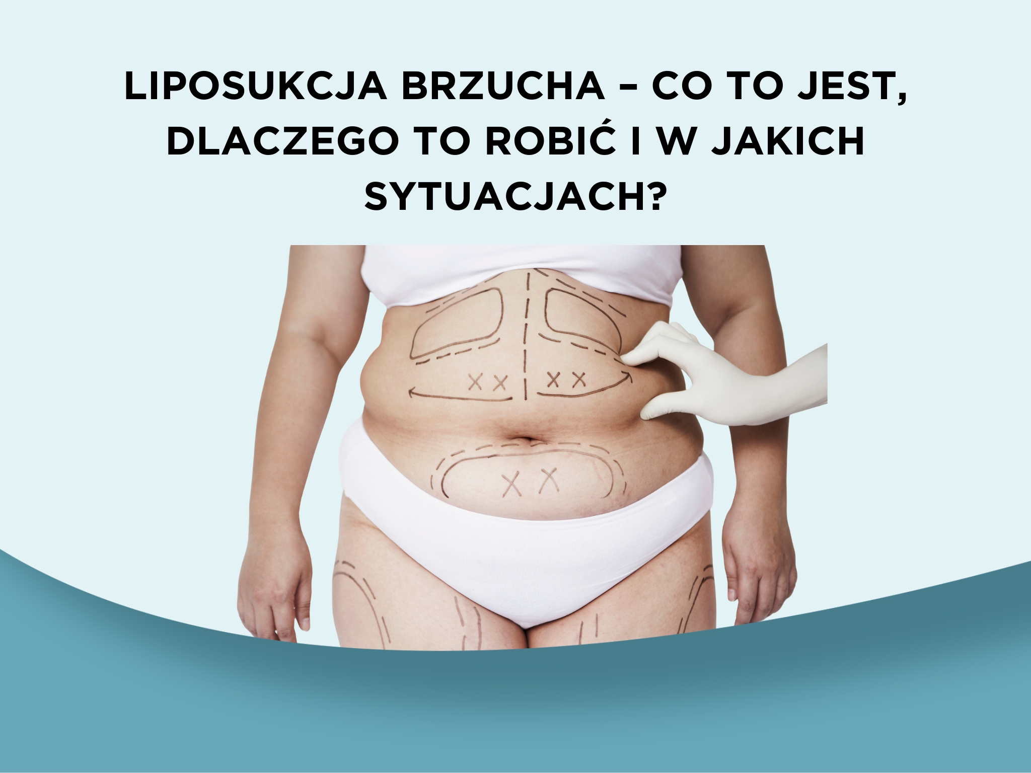 Liposukcja brzucha – co to jest, dlaczego to robić i w jakich sytuacjach?