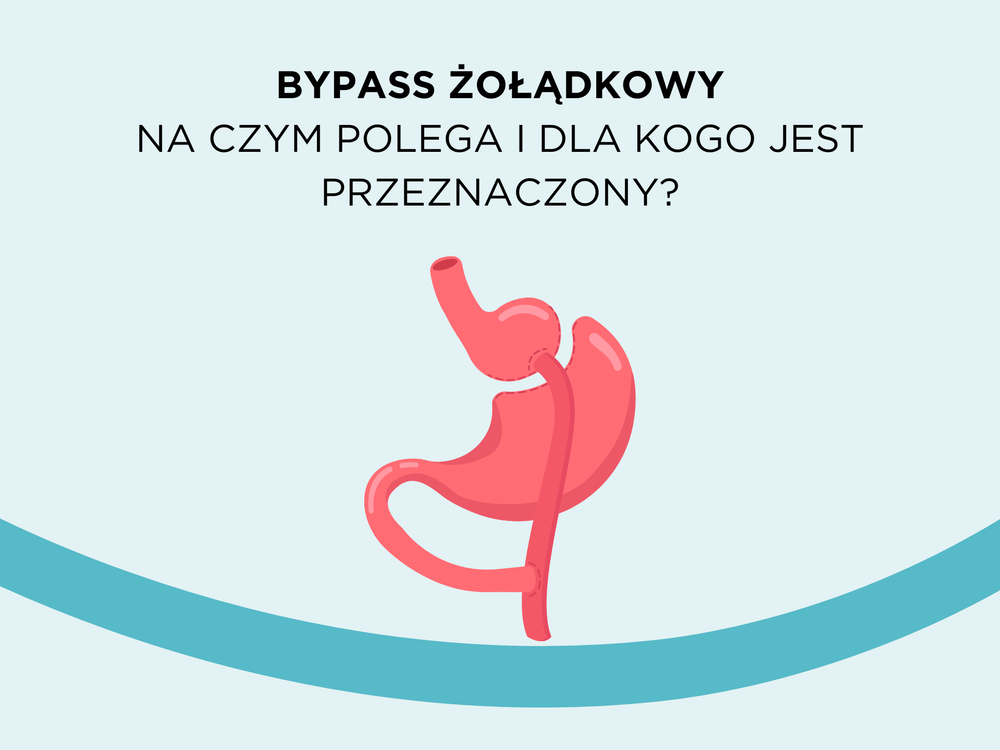 Bypass żołądkowy – na czym polega i dla kogo jest przeznaczony?