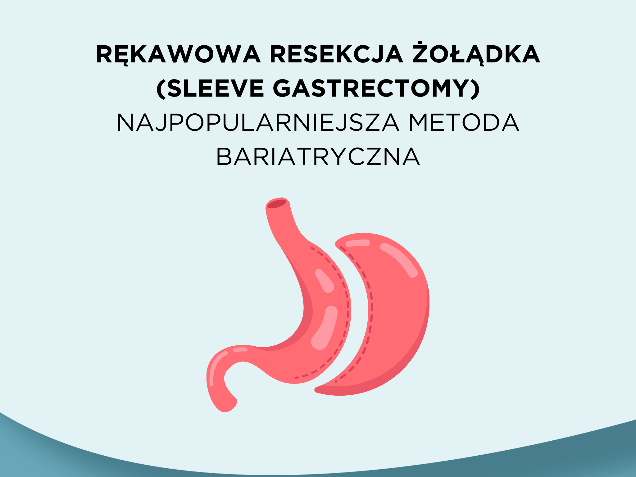 Rękawowa resekcja żołądka (sleeve gastrectomy) – najpopularniejsza metoda bariatryczna