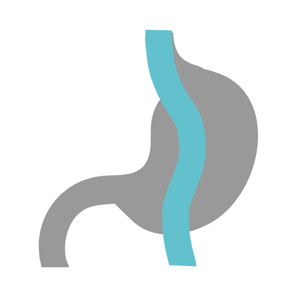 Mini gastric bypass
