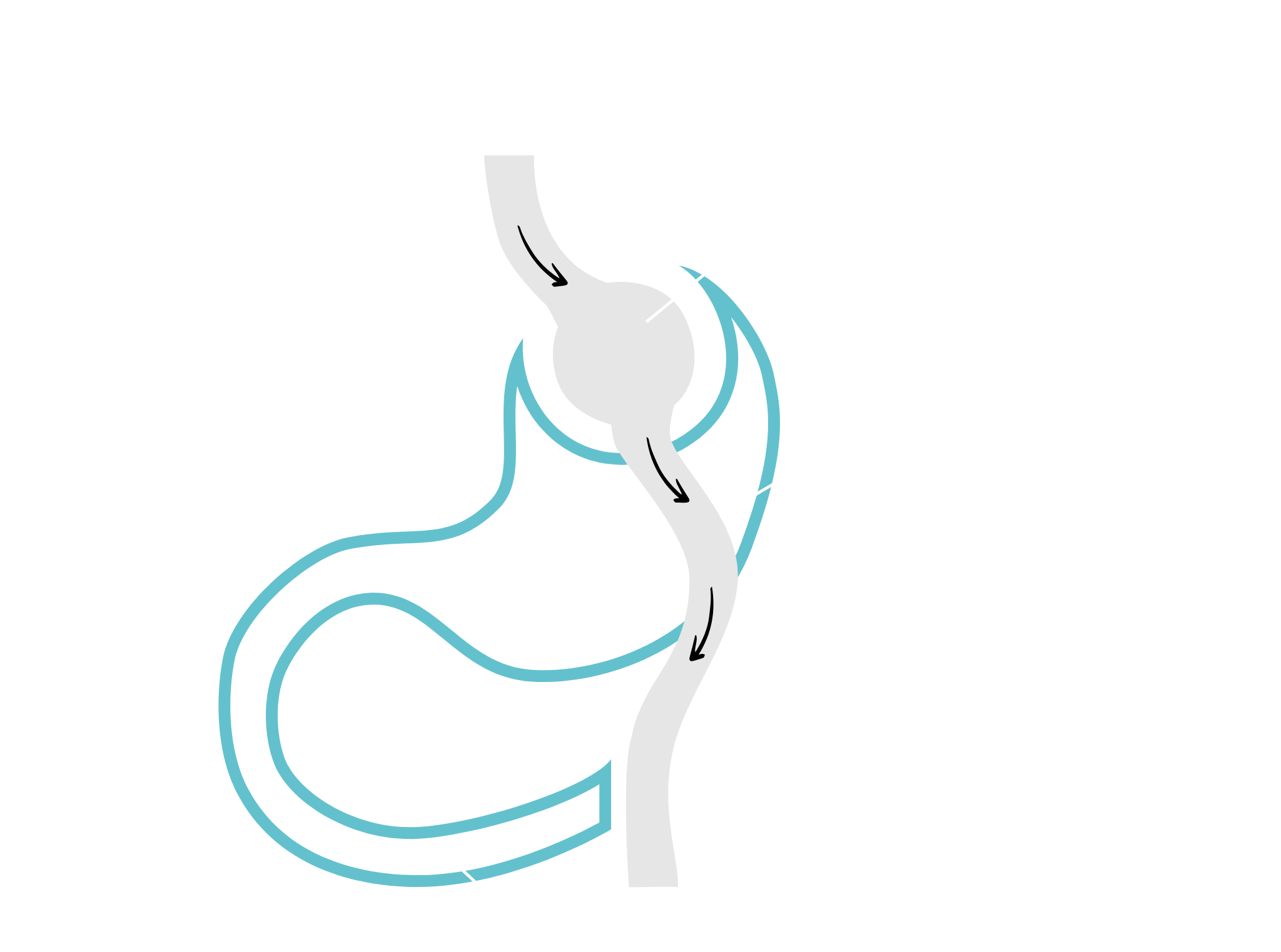 Gastric bypass - po zabiegu