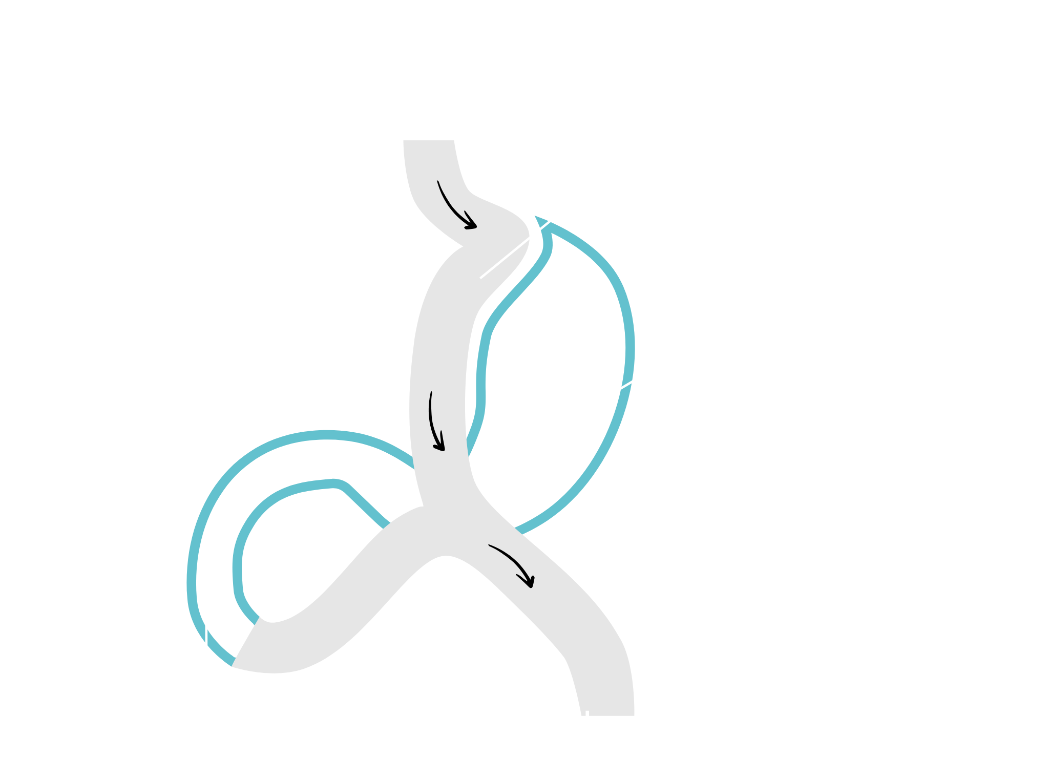 Mini Gastric Bypass - po zabiegu