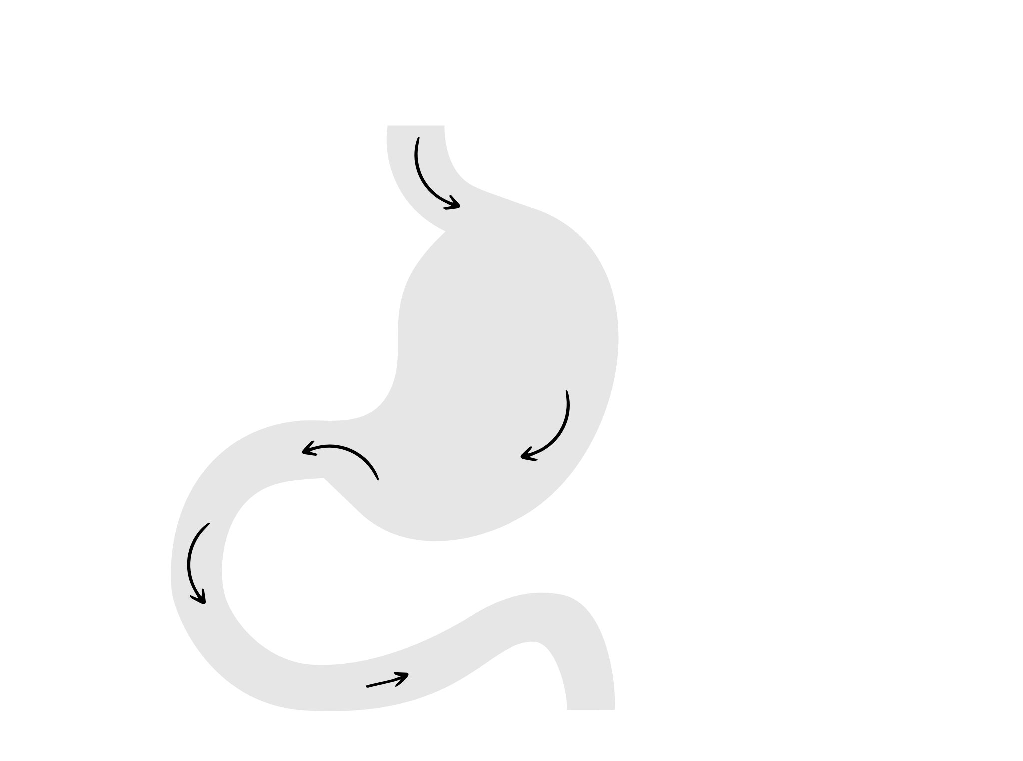 Mini Gastric Bypass - przed zabiegiem