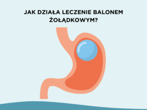 Jak działa leczenie balonem żołądkowym?
